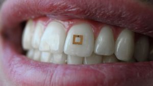 Minúsculo Sensor Usado nos Dentes Pode Ajudá-lo a Ser Mais Saudável